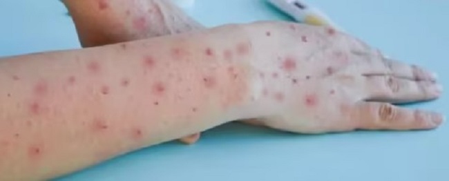 एमपॉक्स के नए स्ट्रेन ने स्वीडन में मचाया कोहराम,,कांगो में 548 मौतें