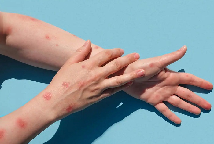 भारत में एमपॉक्स क्लेड 1 की दस्तक